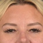 Brow Lift Before & After Patient #3296