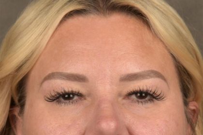 Brow Lift Before & After Patient #3296