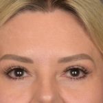 Brow Lift Before & After Patient #3296