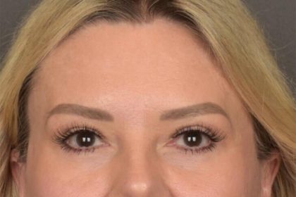 Brow Lift Before & After Patient #3296