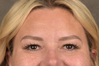 Brow Lift Before & After Patient #3296