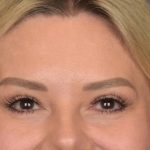 Brow Lift Before & After Patient #3296