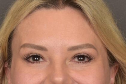 Brow Lift Before & After Patient #3296