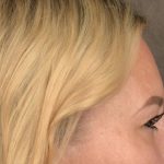 Brow Lift Before & After Patient #3296
