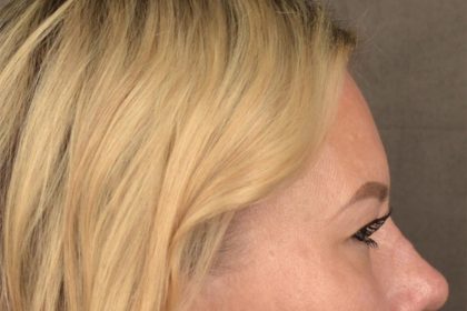 Brow Lift Before & After Patient #3296