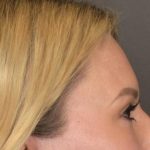 Brow Lift Before & After Patient #3296