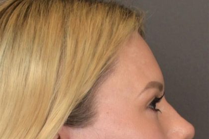 Brow Lift Before & After Patient #3296