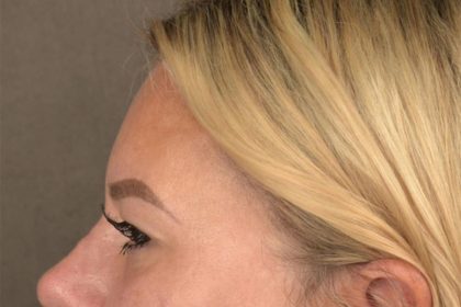 Brow Lift Before & After Patient #3296