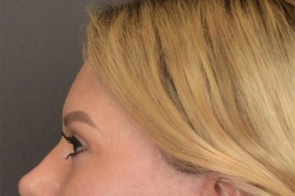 Brow Lift Before & After Patient #3296