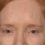 Brow Lift Before & After Patient #3297
