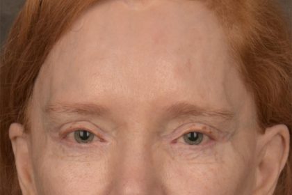 Brow Lift Before & After Patient #3297