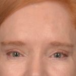 Brow Lift Before & After Patient #3297