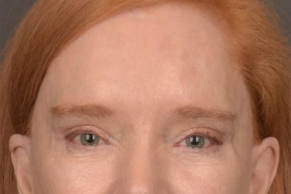 Brow Lift Before & After Patient #3297