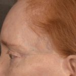 Brow Lift Before & After Patient #3297