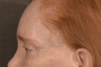 Brow Lift Before & After Patient #3297