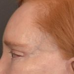 Brow Lift Before & After Patient #3297