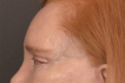 Brow Lift Before & After Patient #3297