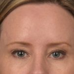 Brow Lift Before & After Patient #3298