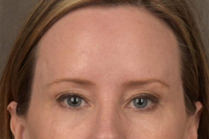 Brow Lift Before & After Patient #3298
