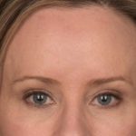 Brow Lift Before & After Patient #3298