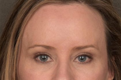 Brow Lift Before & After Patient #3298