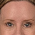 Brow Lift Before & After Patient #3298