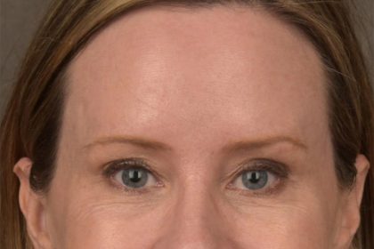Brow Lift Before & After Patient #3298