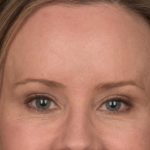 Brow Lift Before & After Patient #3298