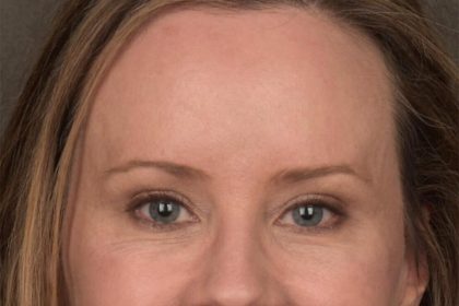 Brow Lift Before & After Patient #3298