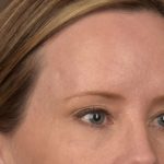 Brow Lift Before & After Patient #3298