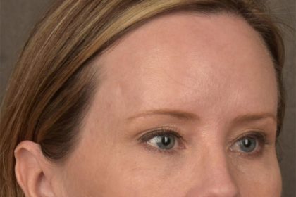 Brow Lift Before & After Patient #3298