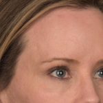 Brow Lift Before & After Patient #3298
