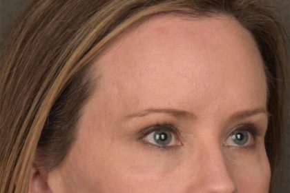 Brow Lift Before & After Patient #3298