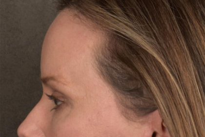 Brow Lift Before & After Patient #3298