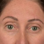 Brow Lift Before & After Patient #3299
