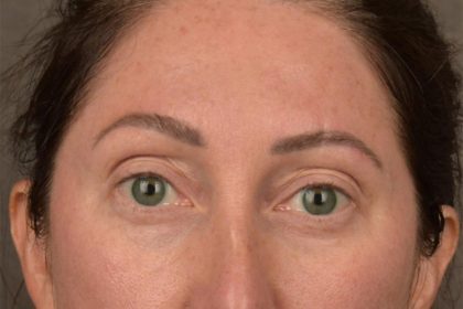 Brow Lift Before & After Patient #3299