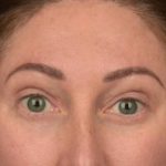 Brow Lift Before & After Patient #3299