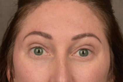 Brow Lift Before & After Patient #3299