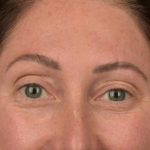 Brow Lift Before & After Patient #3299
