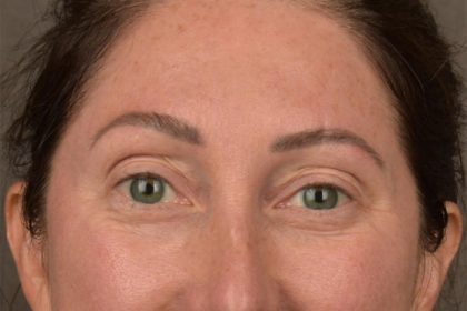 Brow Lift Before & After Patient #3299