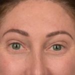 Brow Lift Before & After Patient #3299