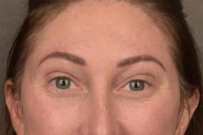 Brow Lift Before & After Patient #3299