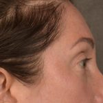Brow Lift Before & After Patient #3299