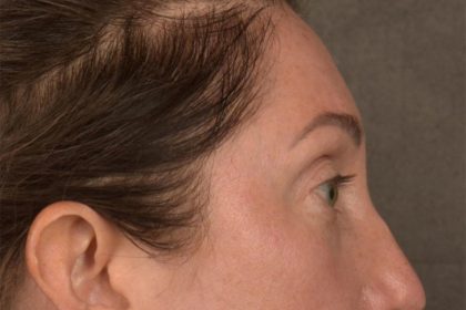 Brow Lift Before & After Patient #3299
