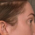 Brow Lift Before & After Patient #3299