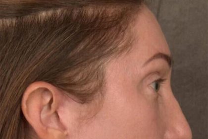 Brow Lift Before & After Patient #3299