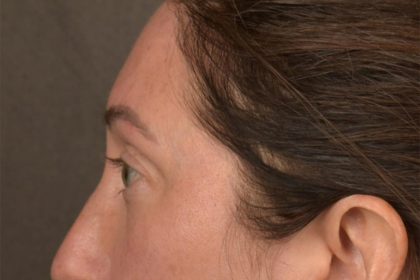 Brow Lift Before & After Patient #3299