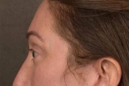 Brow Lift Before & After Patient #3299