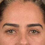 Brow Lift Before & After Patient #3300