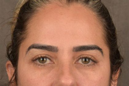 Brow Lift Before & After Patient #3300